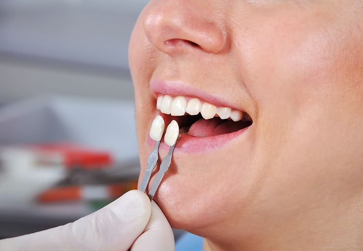 保険治療でも銀歯の使用はひかえています。(コンポレットレジン)